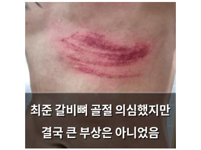 최준 갈비뼈 골절 의심했지만 결국 큰 부상은 아니었음