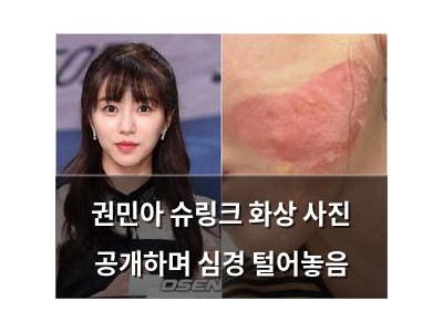 권민아 슈링크 화상 사진 공개하며 심경 털어놓음